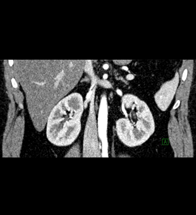 Chromophobe renal cell carcinoma (Radiopaedia 84286-99573 E 45).jpg