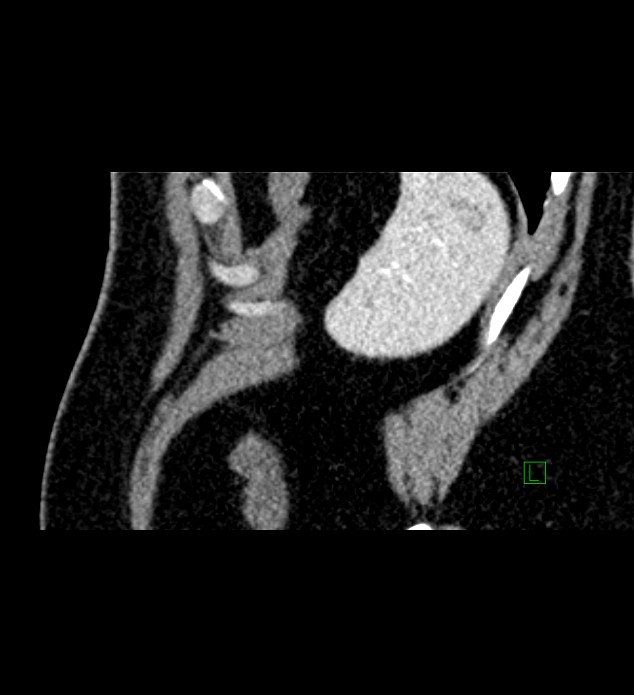 Chromophobe renal cell carcinoma (Radiopaedia 84286-99573 F 11).jpg