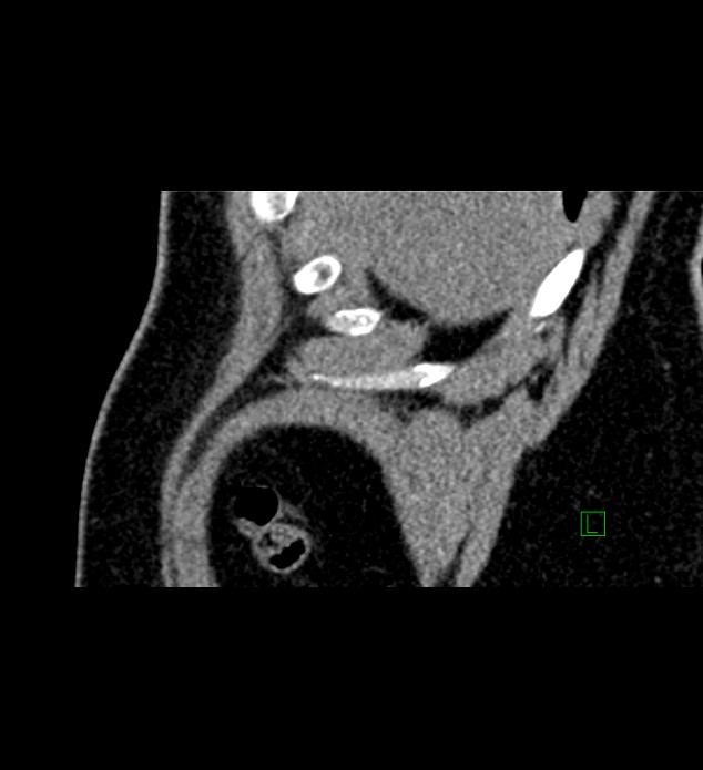 Chromophobe renal cell carcinoma (Radiopaedia 84286-99573 F 168).jpg