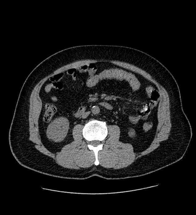 Chromophobe renal cell carcinoma (Radiopaedia 84337-99693 Axial non-contrast 66).jpg