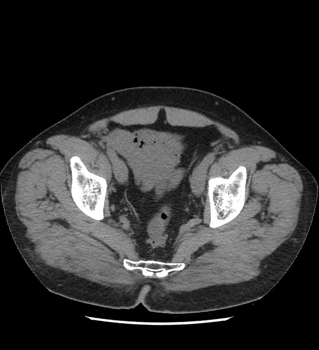 Chromophobe renal cell carcinoma (Radiopaedia 86879-103083 Axial non-contrast 114).jpg