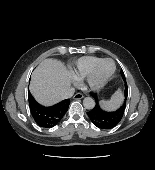Chromophobe renal cell carcinoma (Radiopaedia 86879-103083 D 7).jpg