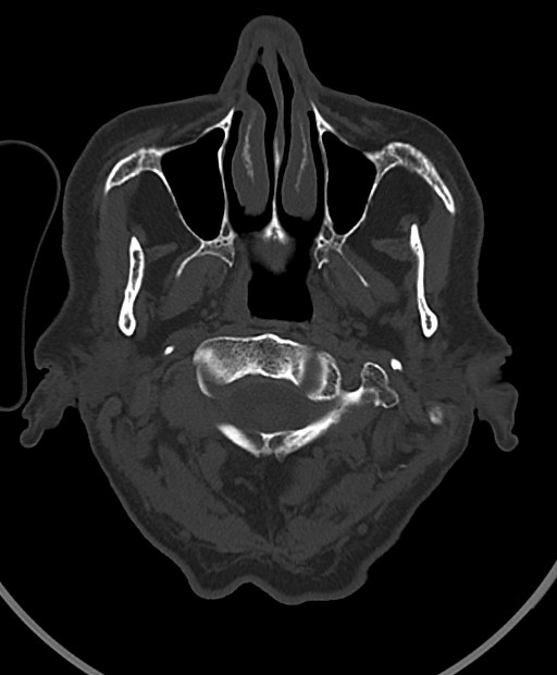 Chronic bilateral subdural hygroma (Radiopaedia 85801-101623 Axial bone window 116).jpg