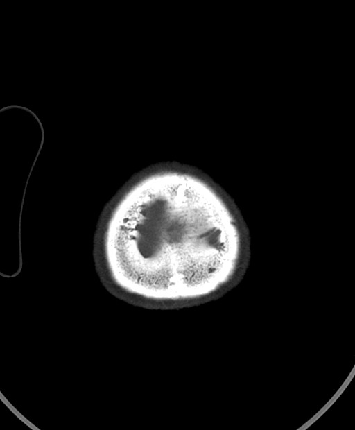 Chronic bilateral subdural hygroma (Radiopaedia 85801-101623 Axial bone window 15).jpg