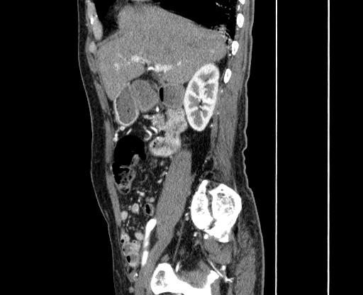 File:Chronic contained rupture of abdominal aortic aneurysm with extensive erosion of the vertebral bodies (Radiopaedia 55450-61901 B 2).jpg