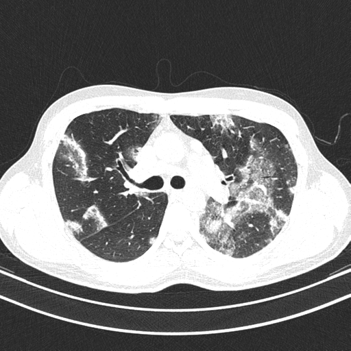 File:Chronic eosinophilic pneumonia (Radiopaedia 39331-41587 Axial lung window 20).png
