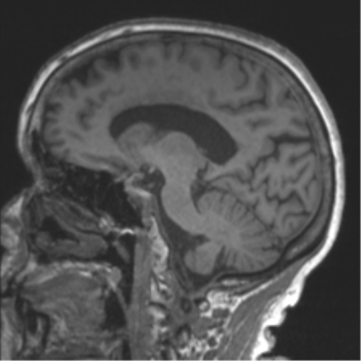 Chronic hypertensive encephalopathy (Radiopaedia 39993-42482 Sagittal T1 42).png