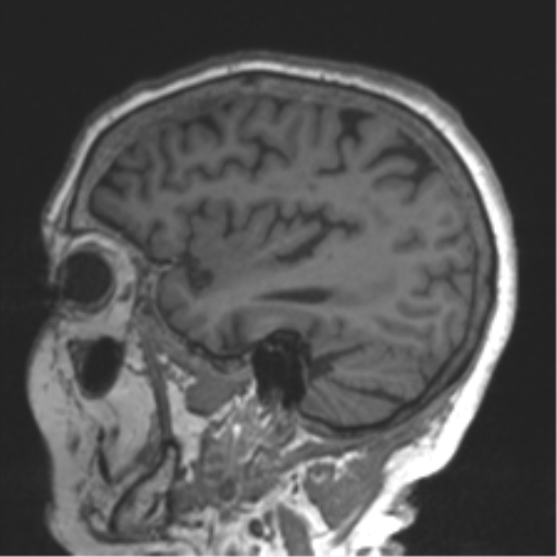 Chronic hypertensive encephalopathy (Radiopaedia 39993-42482 Sagittal T1 68).png