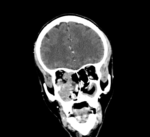Chronic invasive fungal sinusitis with intraorbital and intracranial extension (Radiopaedia 56387-63046 C 114).jpg