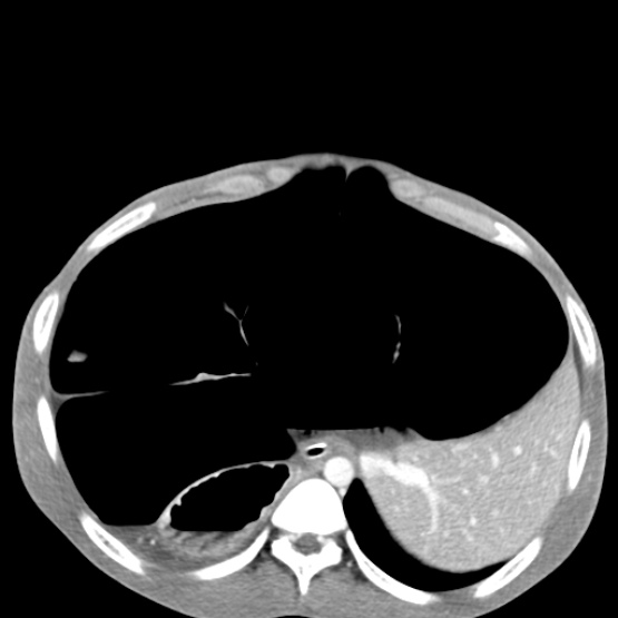 Chronic large bowel pseudo-obstruction (Radiopaedia 43181-46492 A 45).jpg