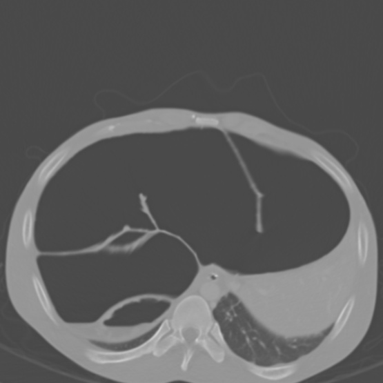 Chronic large bowel pseudo-obstruction (Radiopaedia 43181-46492 Axial bone window 40).jpg