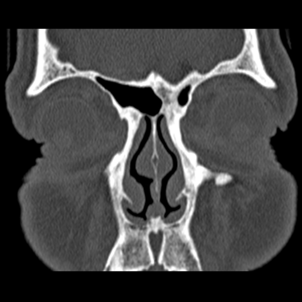 Chronic maxillary sinusitis (Radiopaedia 27879-28116 Coronal bone window 12).jpg