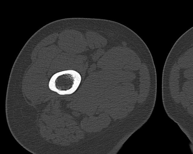 File:Chronic ostemyelitis of the femur with long sinus tract (Radiopaedia 74947-85982 Axial bone window 43).jpg