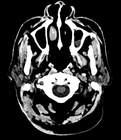File:Chronic osteomyelitis - calvarial (severe) (Radiopaedia 69668-79616 Axial non-contrast 22).jpg