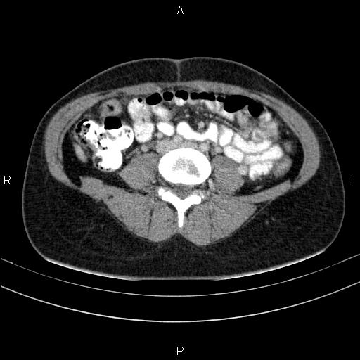 File:Chronic pancreatitis (Radiopaedia 64576-73450 C 104).jpg
