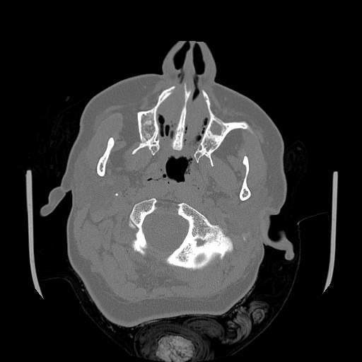 Chronic sinusitis with intra-sinus calcification (Radiopaedia 63919-72668 Axial bone window 73).jpg