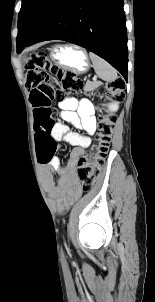 Chronic small bowel volvulus (Radiopaedia 75224-86322 C 38).jpg