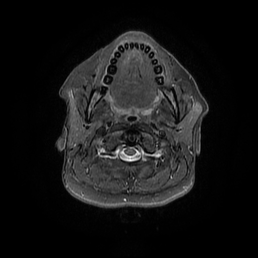 File:Chronic submandibular sialadenitis (Radiopaedia 61852-69885 Axial STIR 10).jpg
