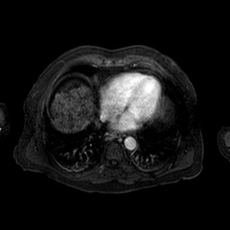 Cirrhosis and hepatocellular carcinoma in the setting of hemochromatosis (Radiopaedia 75394-86594 Axial T1 C+ fat sat 163).jpg