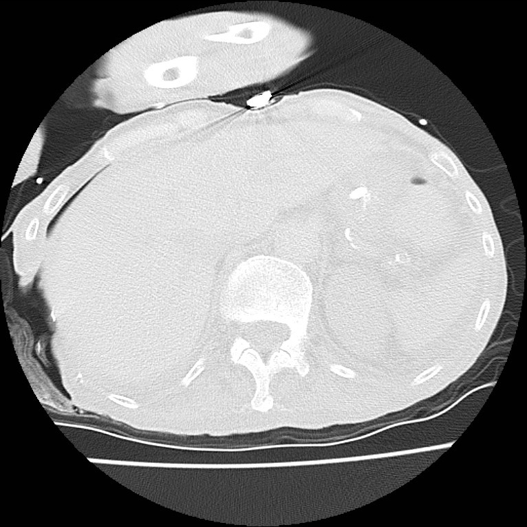 Clagett thoracotomy with bronchopleural fistula (Radiopaedia 29192-29587 Axial lung window 50).jpg