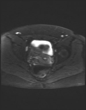 Class II Mullerian duct anomaly- unicornuate uterus with rudimentary horn and non-communicating cavity (Radiopaedia 39441-41755 Axial DWI 18).jpg