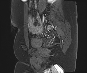 File:Class II Mullerian duct anomaly- unicornuate uterus with rudimentary horn and non-communicating cavity (Radiopaedia 39441-41755 G 24).jpg