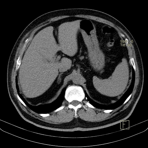 File:Classic complicated silicosis (Radiopaedia 49720-54961 Axial liver window 54).jpg