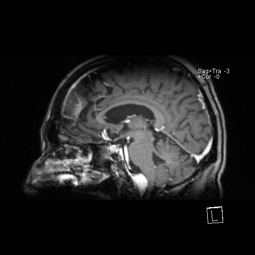 File:Clival meningioma (Radiopaedia 19420).jpg