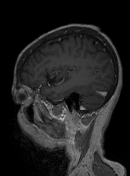Clival meningioma (Radiopaedia 53278-59248 Sagittal T1 C+ 332).jpg