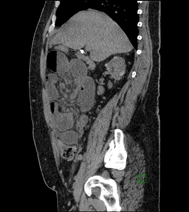 Closed-loop small bowel obstruction-internal hernia (Radiopaedia 78439-91096 C 96).jpg