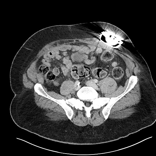 File:Closed loop obstruction - internal hernia into nephrectomy bed (Radiopaedia 59867-67320 A 100).jpg