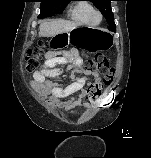 Closed loop obstruction - internal hernia into nephrectomy bed (Radiopaedia 59867-67320 B 26).jpg