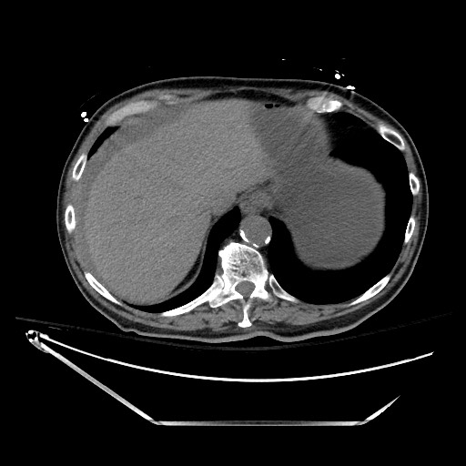 Closed loop obstruction due to adhesive band, resulting in small bowel ischemia and resection (Radiopaedia 83835-99023 Axial non-contrast 29).jpg
