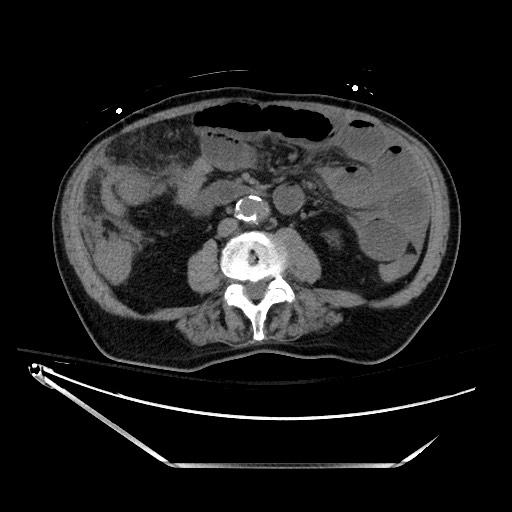 File:Closed loop obstruction due to adhesive band, resulting in small bowel ischemia and resection (Radiopaedia 83835-99023 Axial non-contrast 82).jpg