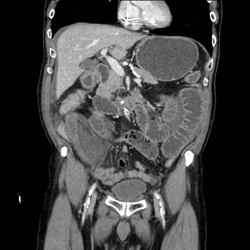 Closed loop obstruction due to adhesive band, resulting in small bowel ischemia and resection (Radiopaedia 83835-99023 E 55).jpg