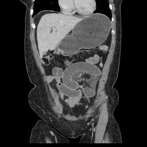 File:Closed loop small bowel obstruction (Radiopaedia 65403-74451 B 37).jpg