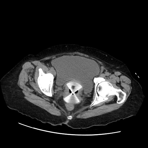 File:Closed loop small bowel obstruction due to adhesive band, with intramural hemorrhage and ischemia (Radiopaedia 83831-99017 Axial non-contrast 145).jpg