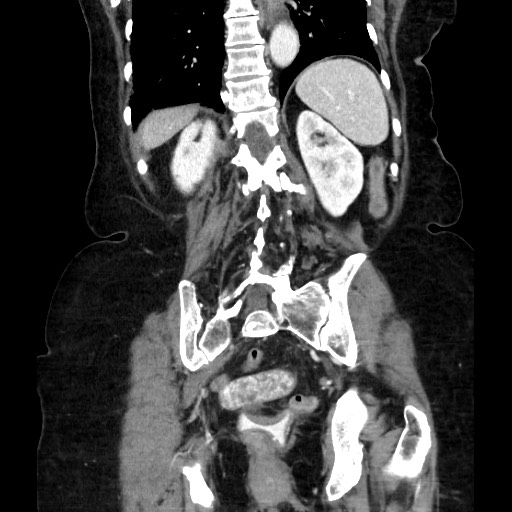 Closed loop small bowel obstruction due to adhesive band, with intramural hemorrhage and ischemia (Radiopaedia 83831-99017 C 92).jpg