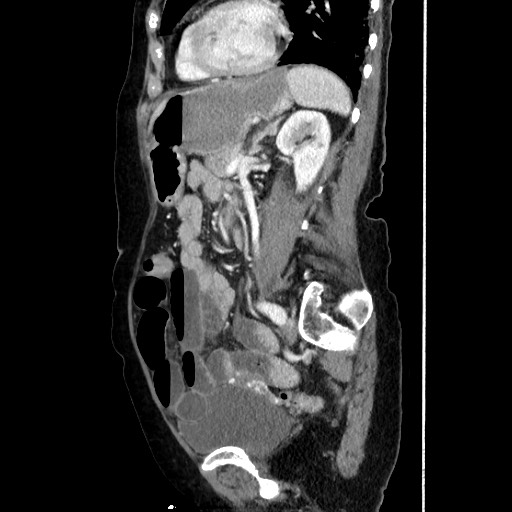 Closed loop small bowel obstruction due to adhesive band, with intramural hemorrhage and ischemia (Radiopaedia 83831-99017 D 123).jpg