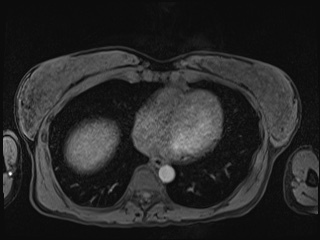Closed loop small bowel obstruction in pregnancy (MRI) (Radiopaedia 87637-104031 Axial T1 fat sat 6).jpg