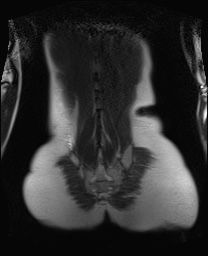File:Closed loop small bowel obstruction in pregnancy (MRI) (Radiopaedia 87637-104031 Coronal T2 48).jpg