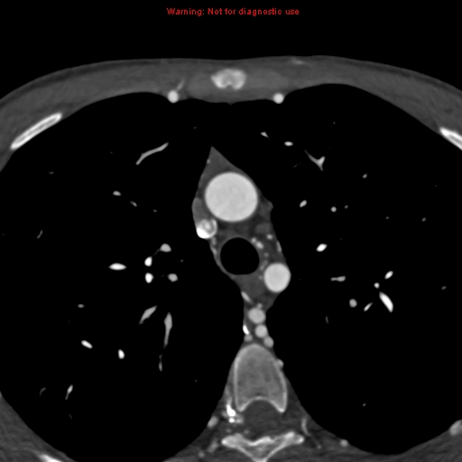 File:Coarctation of the aorta (Radiopaedia 12461-12697 A 99).jpg