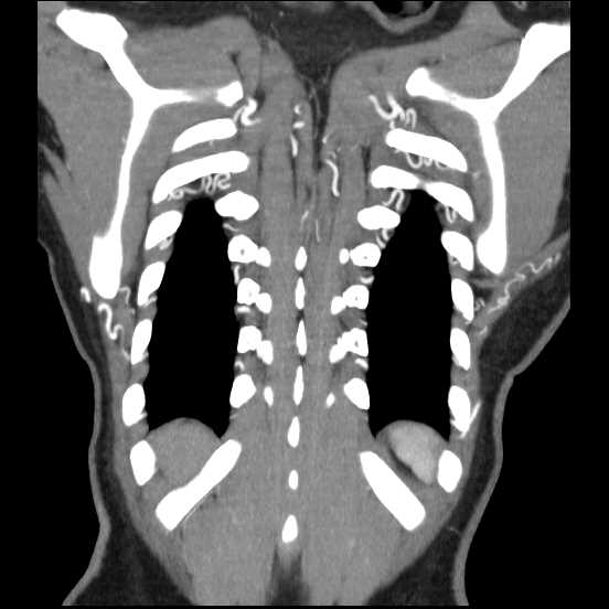 File:Coarctation of the aorta (Radiopaedia 67609-77010 B 9).jpg