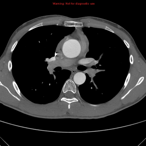 File:Coarctation of the aorta (Radiopaedia 9434-10118 A 85).jpg