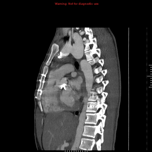 Coarctation of the aorta (Radiopaedia 9434-10118 B 32).jpg