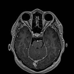 Cochlear incomplete partition type III associated with hypothalamic hamartoma (Radiopaedia 88756-105498 Axial T1 C+ 78).jpg