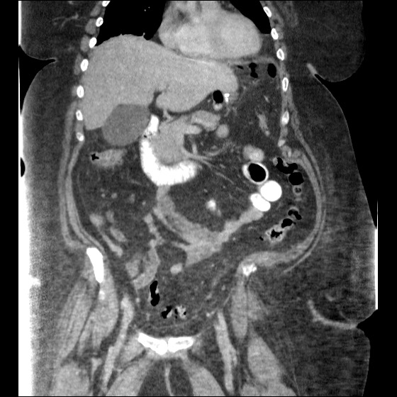 File:Collection due to leak after sleeve gastrectomy (Radiopaedia 55504-61972 B 23).jpg
