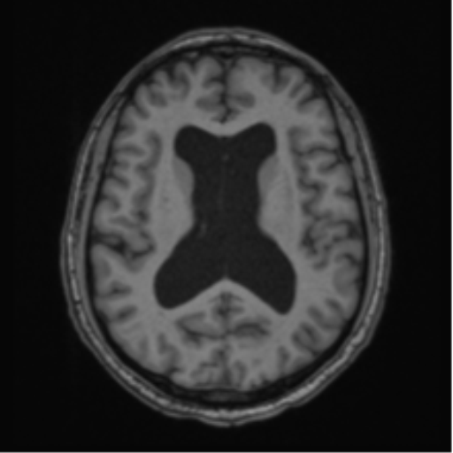 File:Colloid cyst of the third ventricle (Radiopaedia 86571-102662 Axial T1 45).png