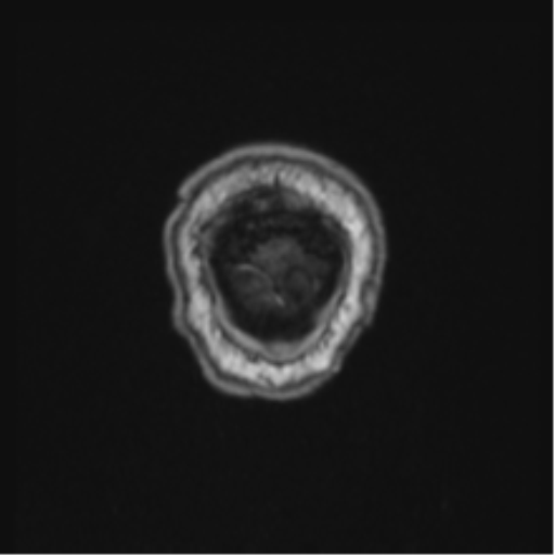 Colloid cyst of the third ventricle (Radiopaedia 86571-102662 Coronal T1 4).png