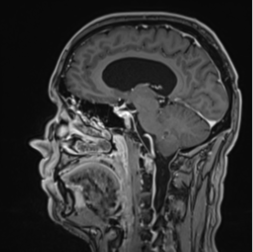 File:Colloid cyst of the third ventricle (Radiopaedia 86571-102662 Sagittal T1 C+ 35).png
